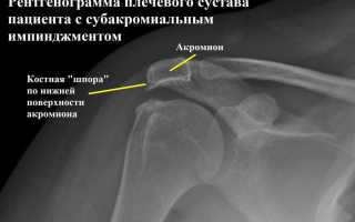 Лечение импичмент синдрома плечевого сустава