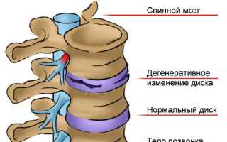 Гимнастика при корешковом синдроме грудного отдела