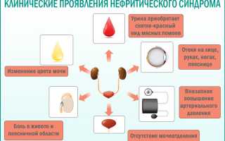 Мочевой нефротический и нефритический синдромы отличия