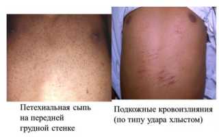 Кожный геморрагический синдром от прадаксы