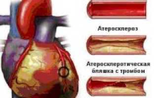 Острый коронарный синдром что такое