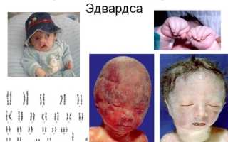 Синдром радиальной кольцевидной 18 хромосомы