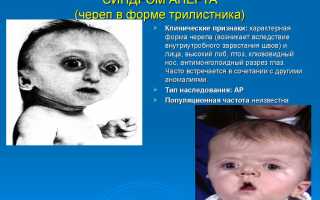 Синдром апера что это какое