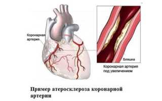 Синдром стенокардии хсн 1 фк 2