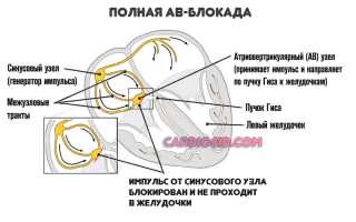 Признаки синдрома фредерика на экг