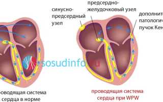 Что нельзя при синдроме впв