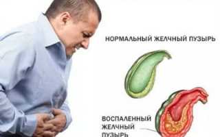 Болевой синдром при заболевании желчного пузыря