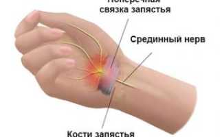 Запястный туннельный синдром при беременности