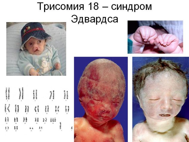 Синдром радиальной кольцевидной 18 хромосомы