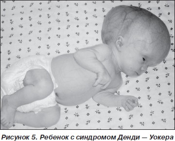 Чем лечить синдром денди уокера
