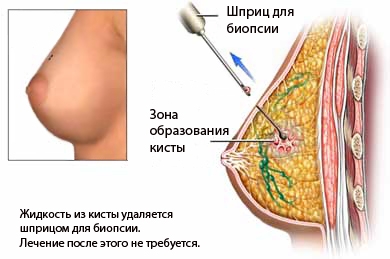 Что такое киста молочной железы