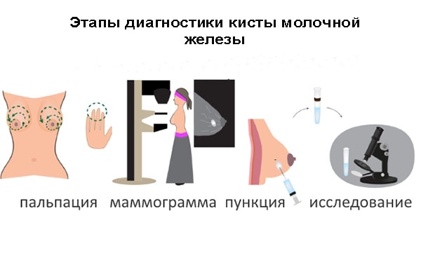 диагностика кисты молочной железы