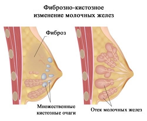 Фиброзная киста молочной железы