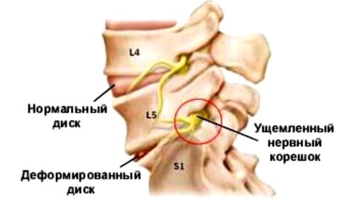 Поясничный остеохондроз с корешковым синдромом лечение