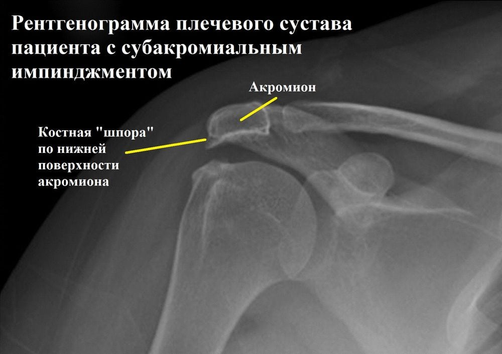 Лечение импичмент синдрома плечевого сустава