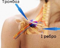 Синдром Педжета-Шреттера