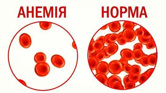Анемия