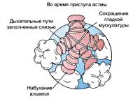 Атопическая бронхиальная астма