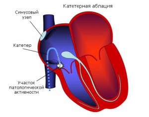 Синдром укороченного интервала что это