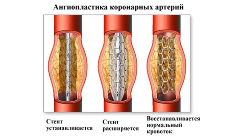 Стент