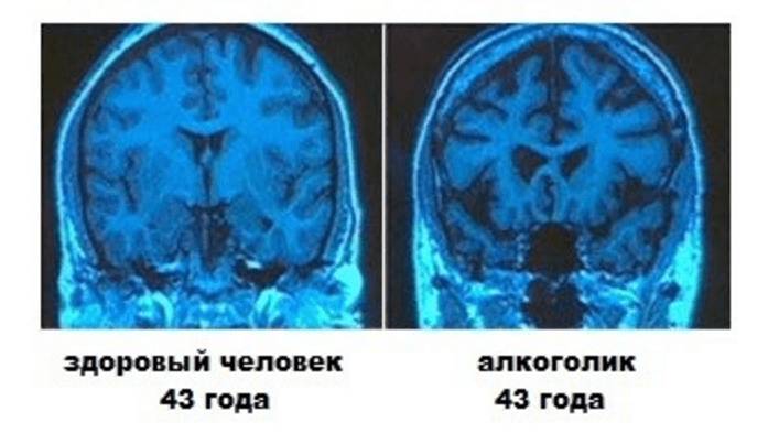 Энцефалопатия головного мозга на снимке