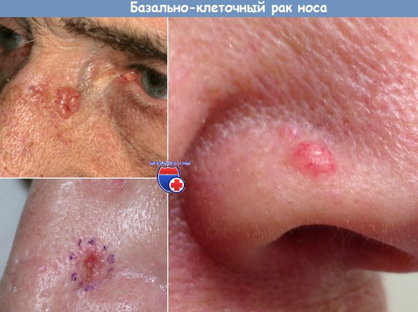 Базально-клеточный рак носа