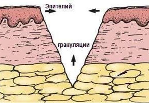 Заживление ран грануляцией
