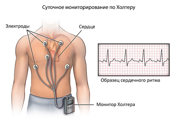 суточное мониторирование по холтеру