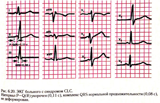 Синдром clc связывают с функционированием пучка