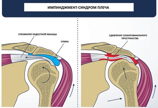Лечение импичмент синдрома плечевого сустава
