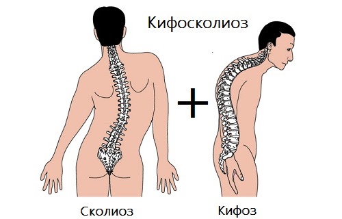 При кифосколиозе наблюдаются искривления позвоночника в двух проекциях
