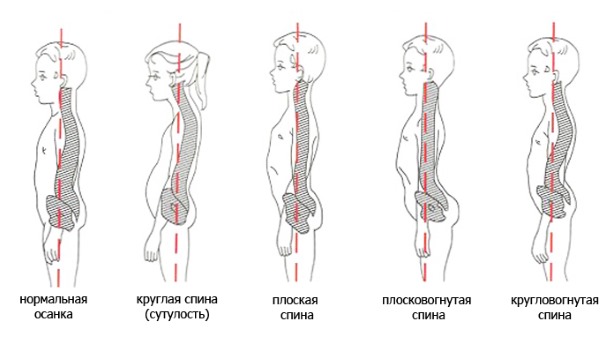 Обратите внимание как выглядят деформации позвоночника