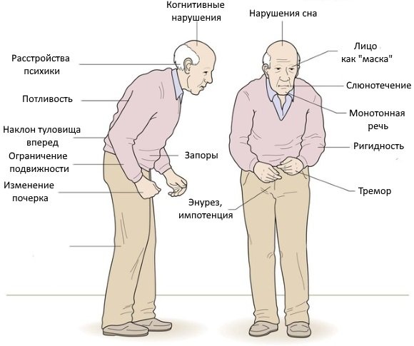 Симптомы болезни Паркинсона
