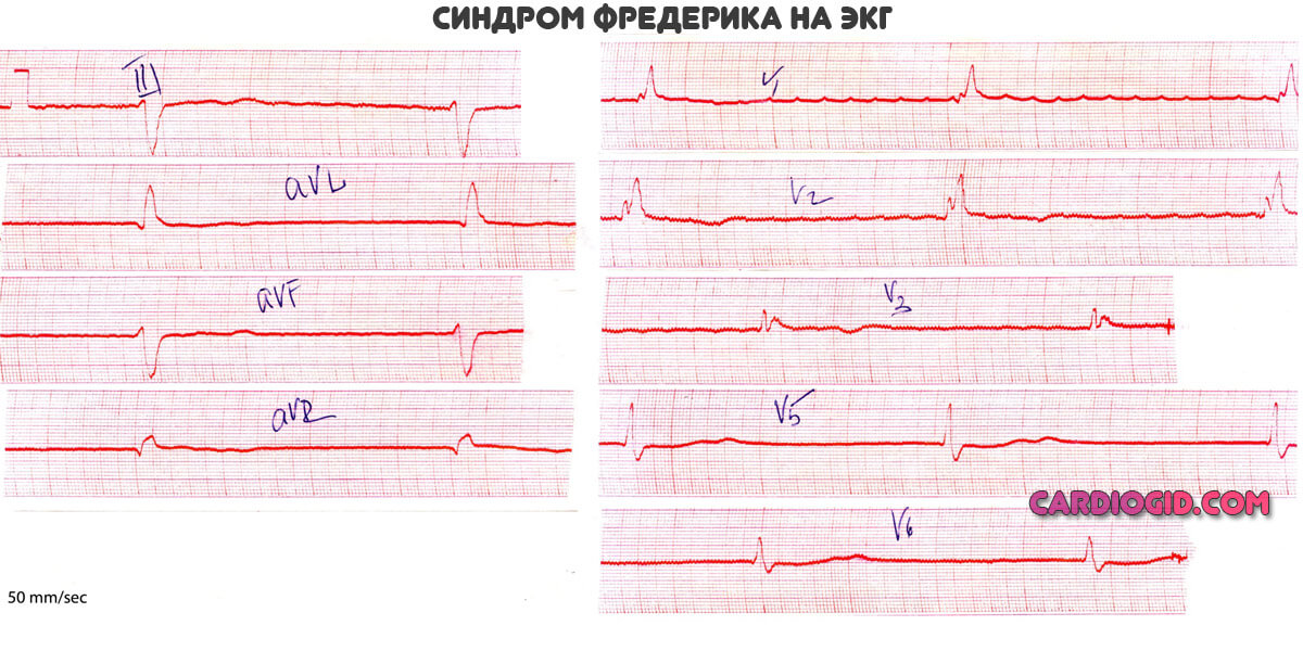 синдром-фредерика-на-экг
