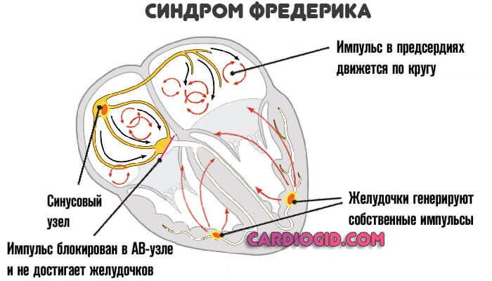 синдром-фредерика