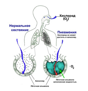 Двусторонняя пневмония у тяжелых больных