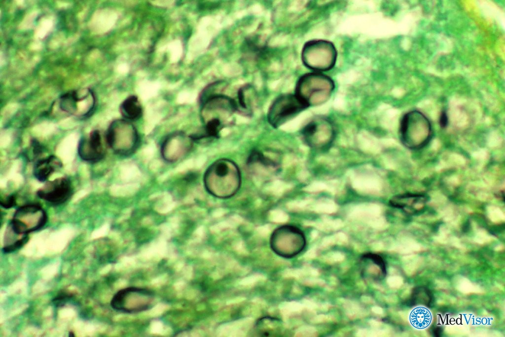 Грибковая пневмония Лечение пневмонии без температуры у взрослых