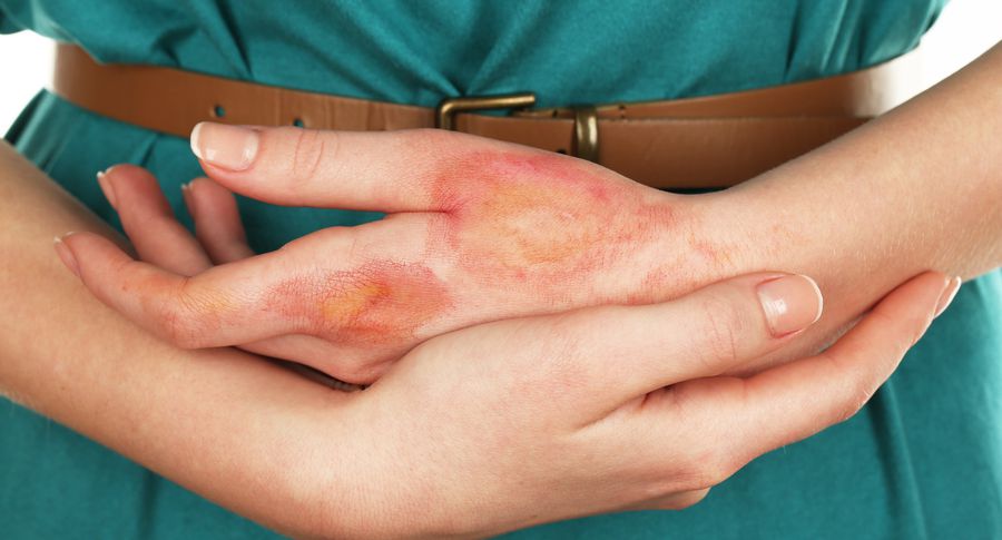 ожог уксусом