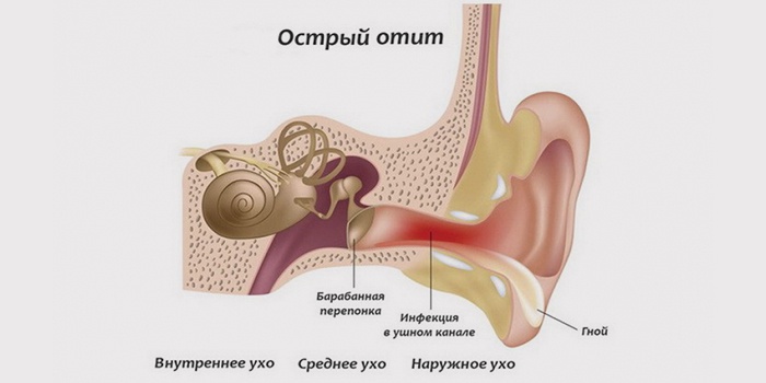 Острый средний не гнойный отит