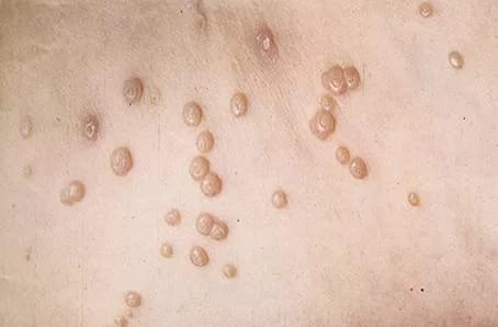 На пенисе как ожог что это