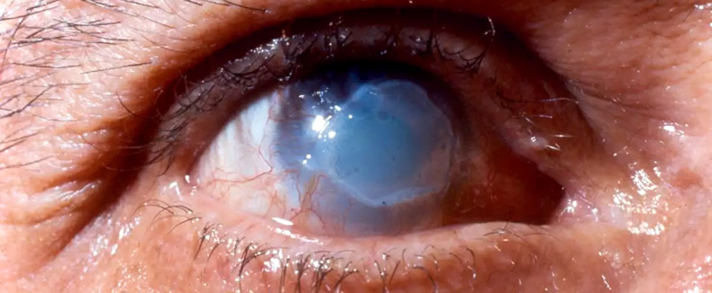 Ожоги глаз Ожоги глаз