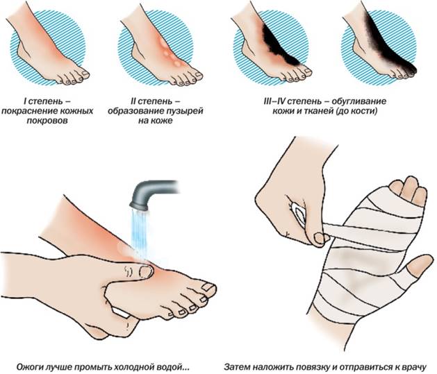 Жалобы больного с ожогами кожи