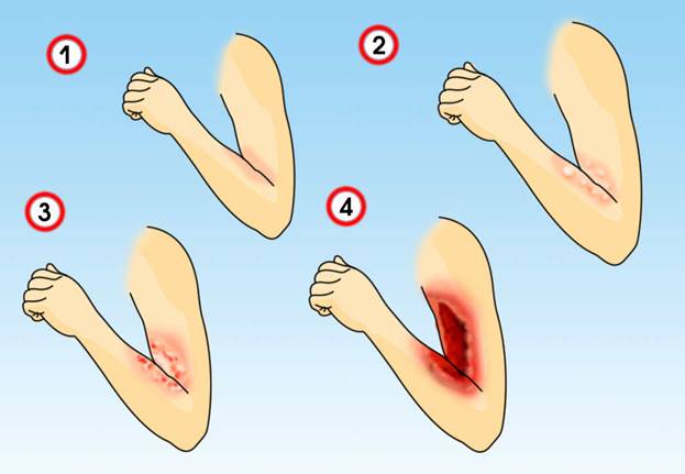 Жалобы больного с ожогами кожи