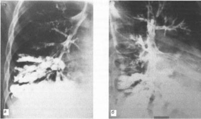 Краевые бронхоэктазы