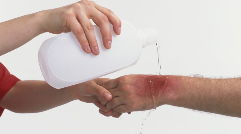 первая помощь при ожоге уксусом