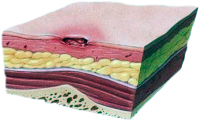 Вторая степень пролежней. Стерильно.com