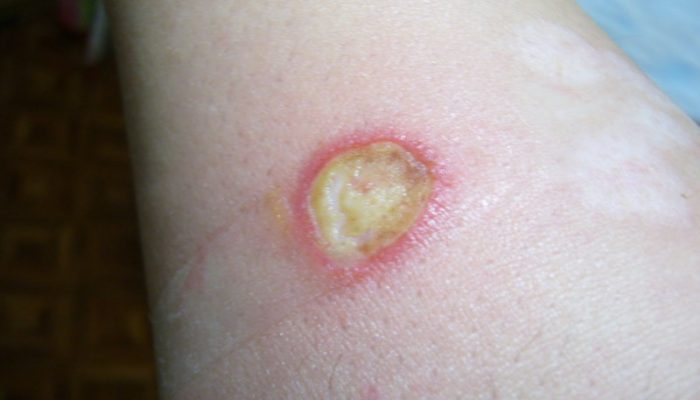 Ожог белый налет в ране