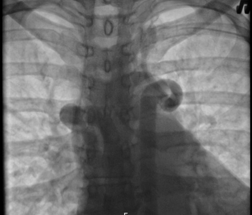 Крупозная пневмония