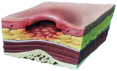 Третья степень пролежней. Стерильно.com