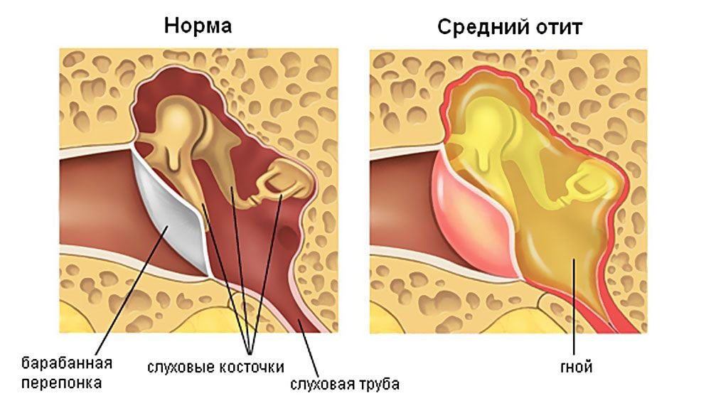 Острый средний не гнойный отит